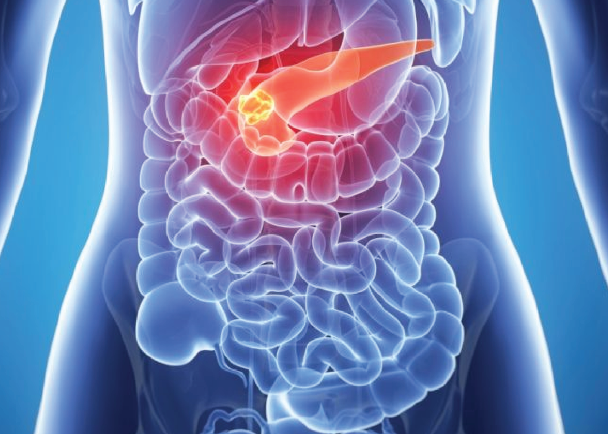Tumors in pancreas
