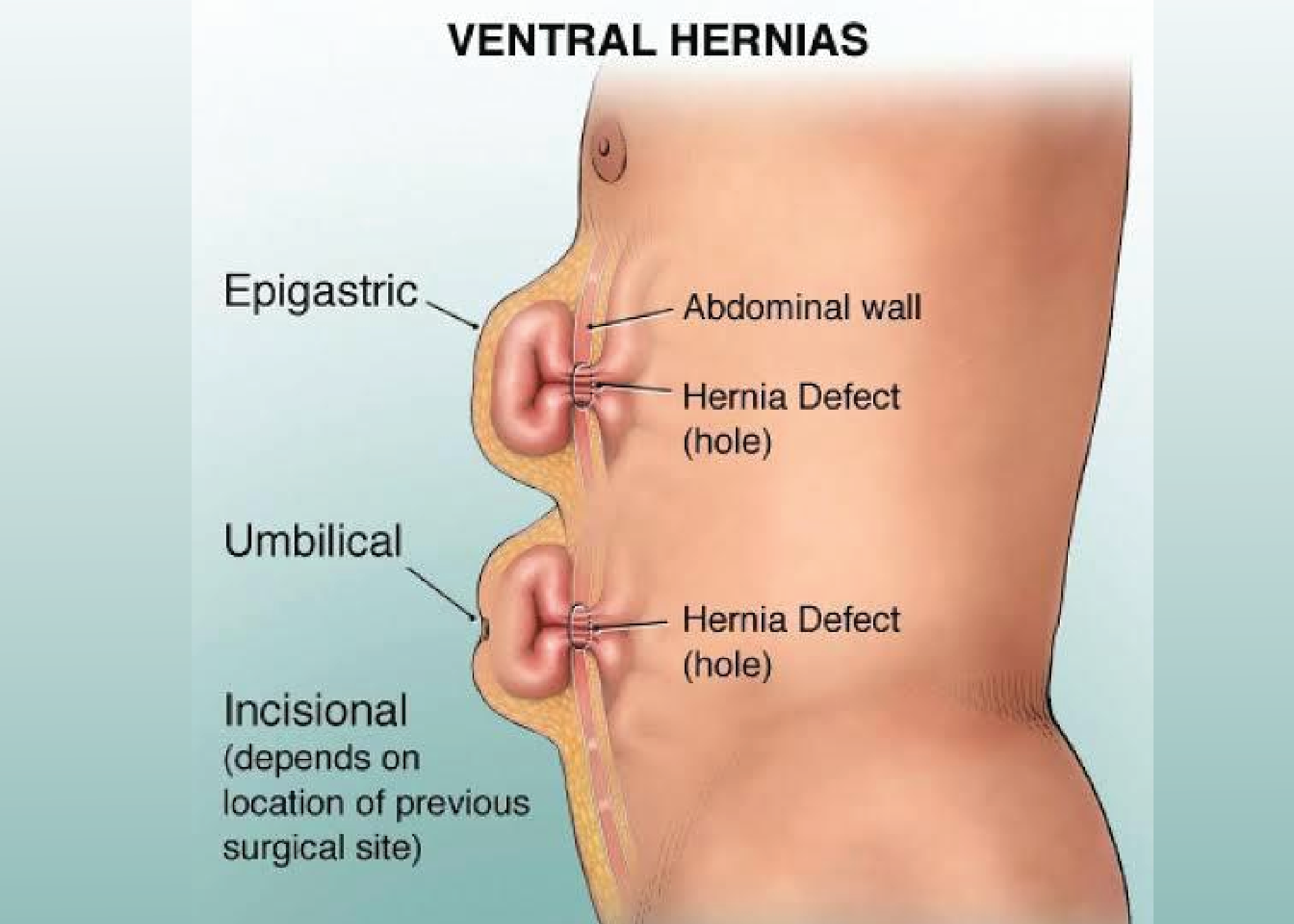 Ventral hernia