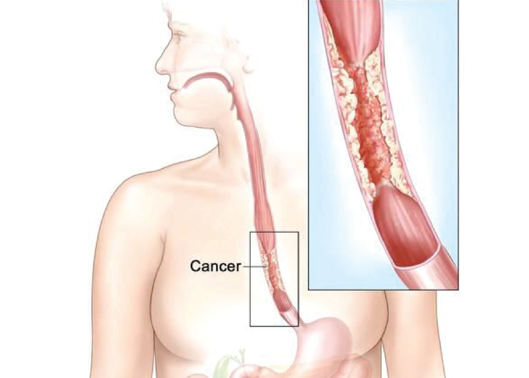 Cancer esophagus