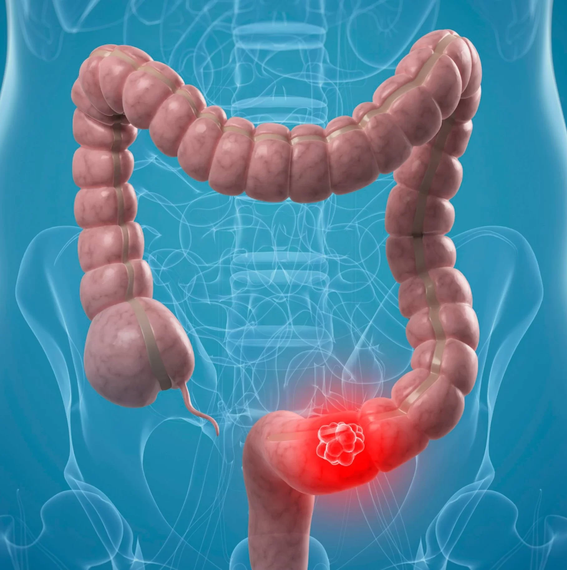 Colonic-Cancer (1)