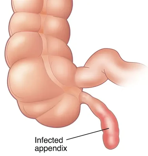 appendicitis