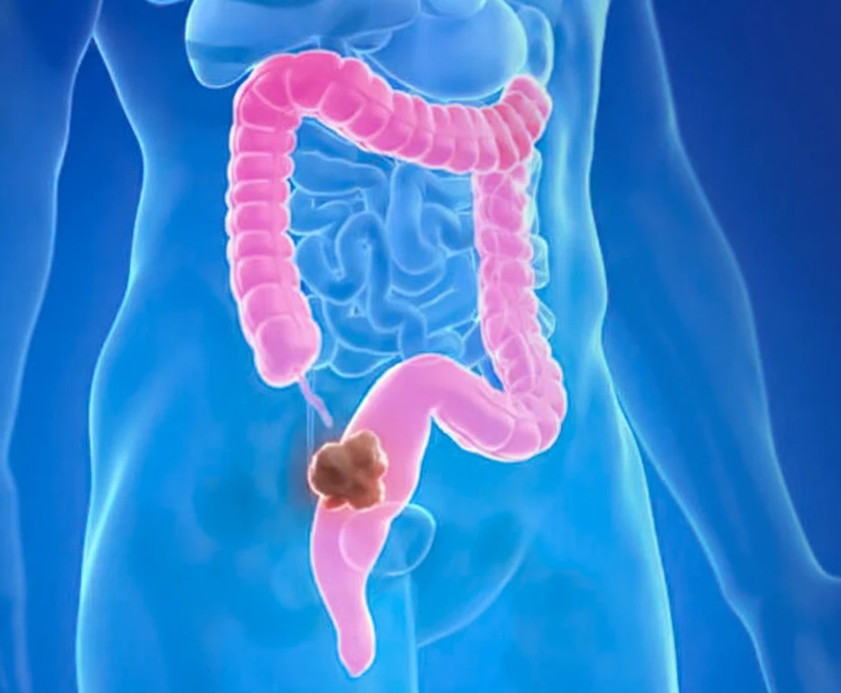 colonic-cancer