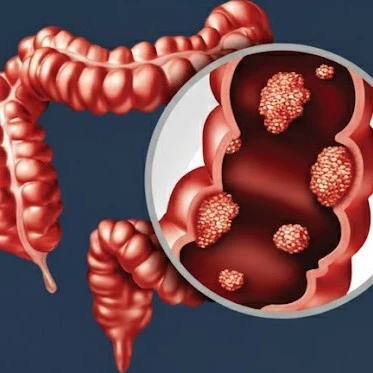 colonic-tuberculosis