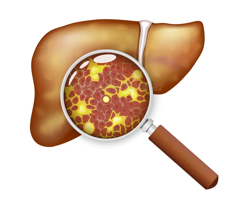 fatty-liver