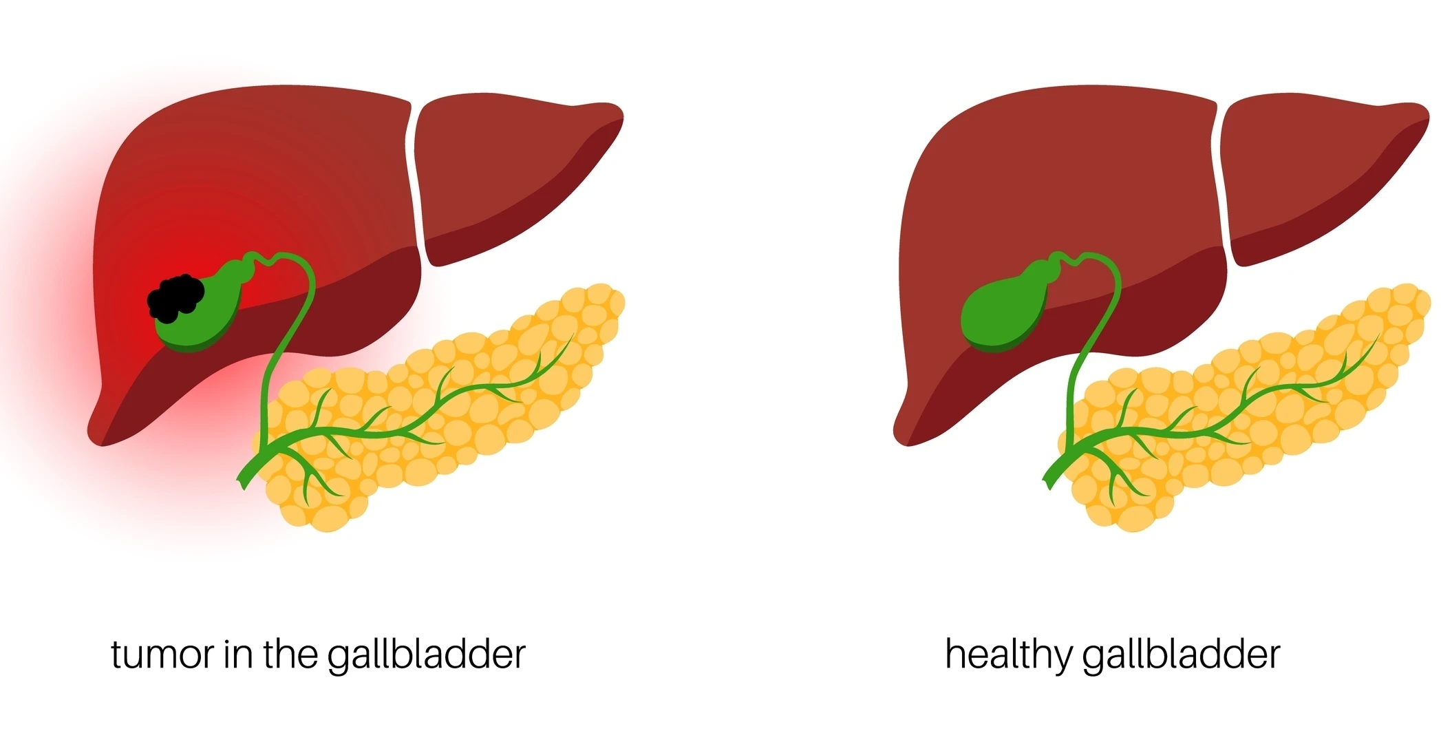 gall-bladder-tumour