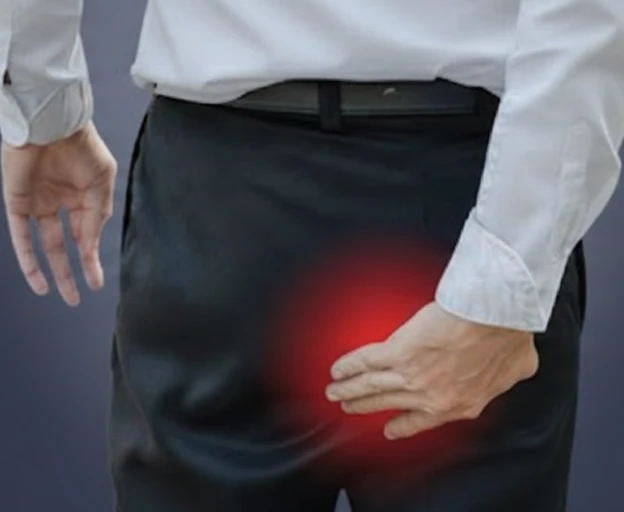 hemorrhoids-piles-2 (2)