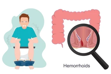 hemorrhoids-piles