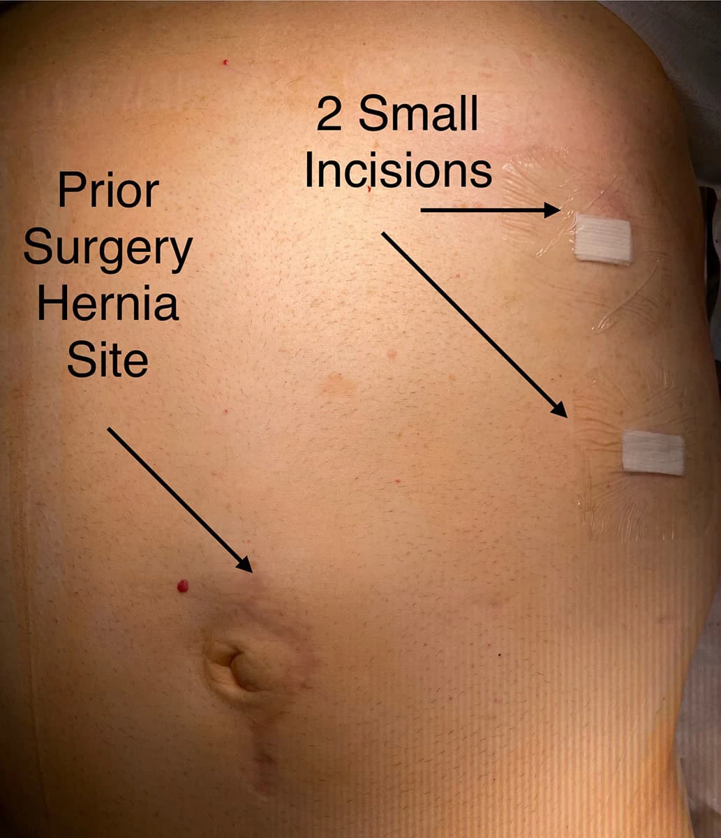 incisional-hernias
