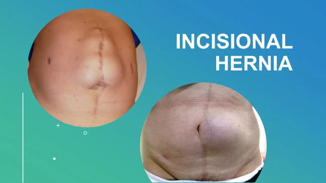 incisional-hernias