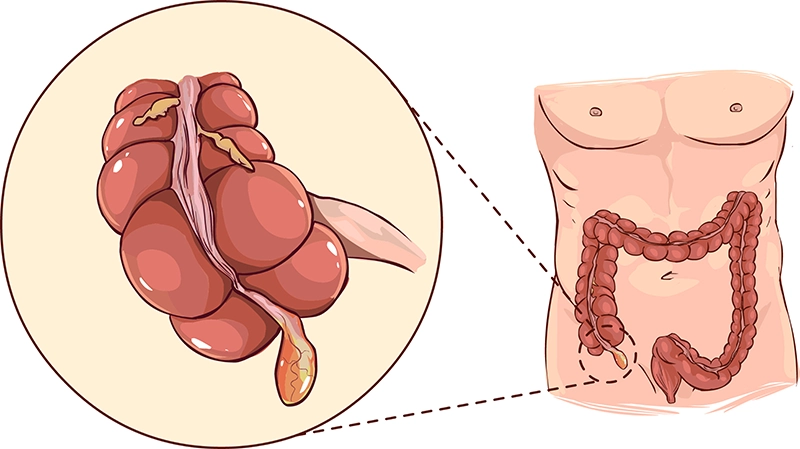 tumor-in-appendix
