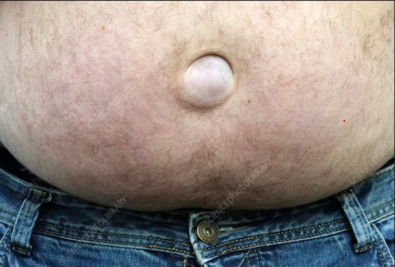umbilical-hernia